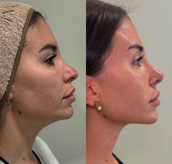 Pómulos y tercio medio