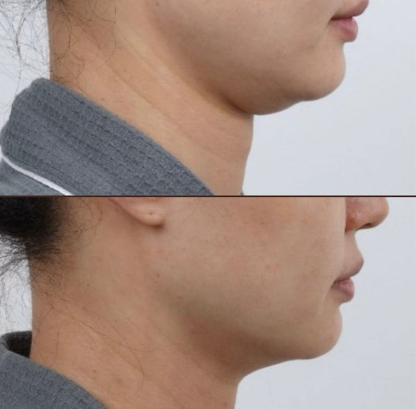 ULTRAFORMER + INDUCTORES DE COLÁGENO